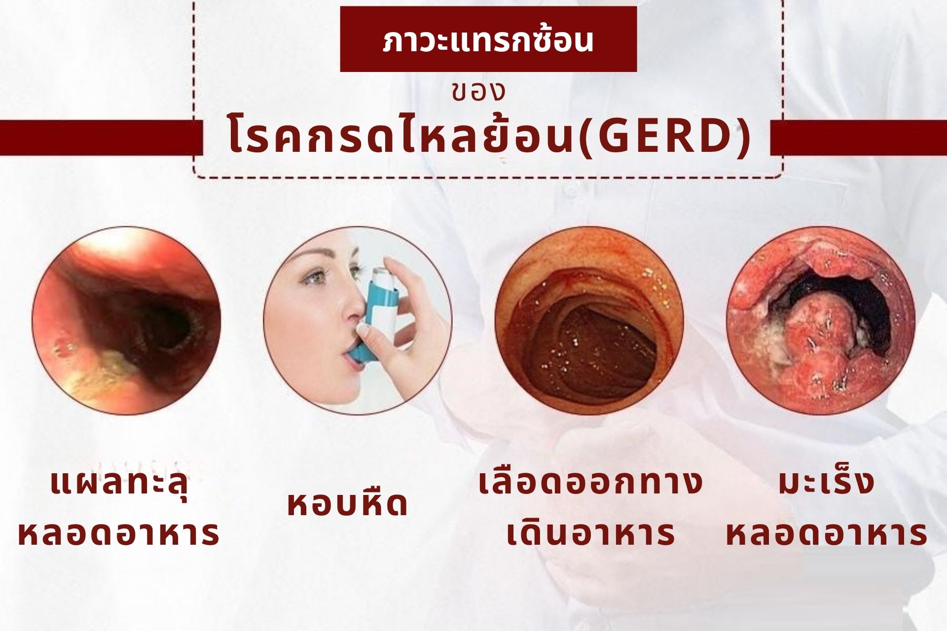 ภาวะแทรกซ้อนจากกรดไหลย้อน